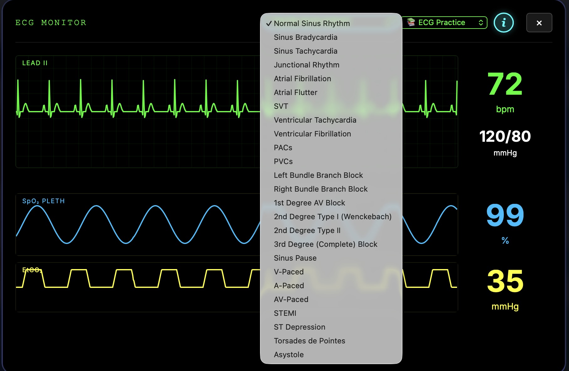 ECG Rhythm Menu